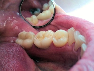 PBC on LL6 and Composite inlay LL7