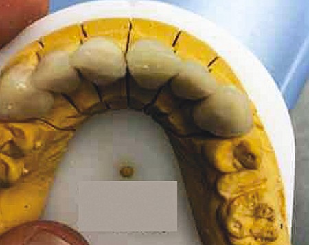 Pre-op of 6 anterior crowns