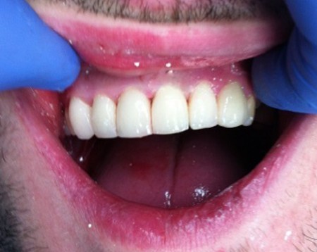 Temporary Crowns fitted